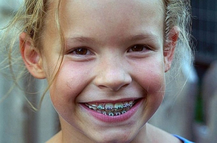 niña con brackets sonriendo