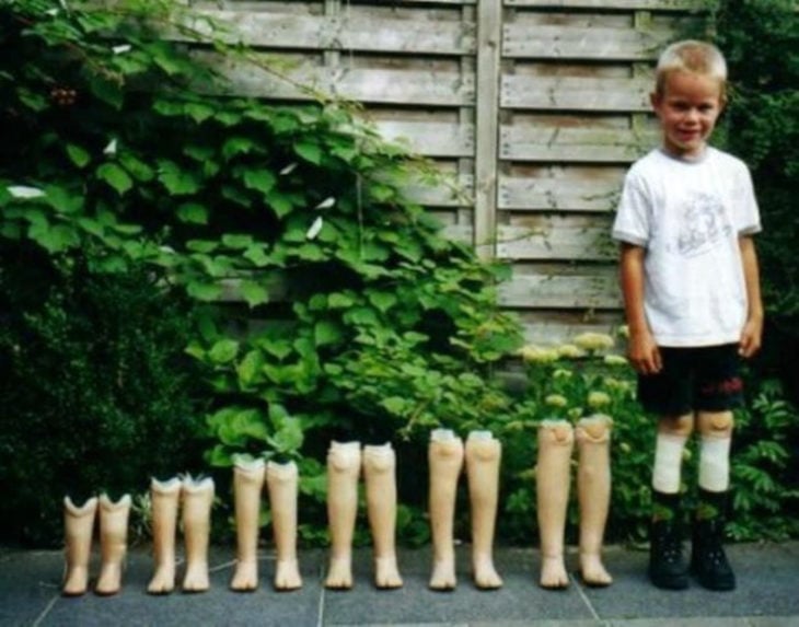 foto prótesis de niño conforme parsa el tiempo 