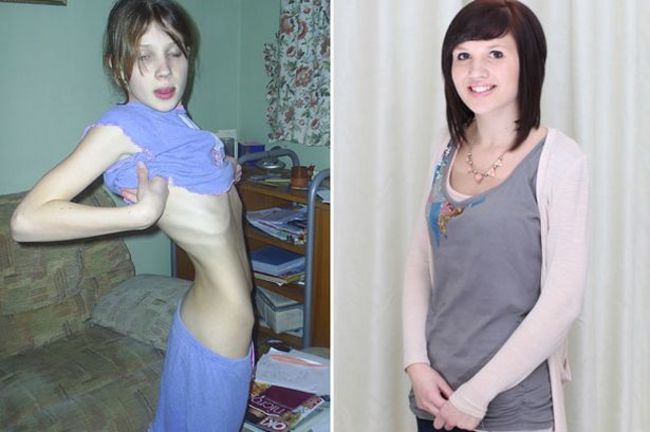 le quedaban días para morir por la anorexia, ya esta recuperada 