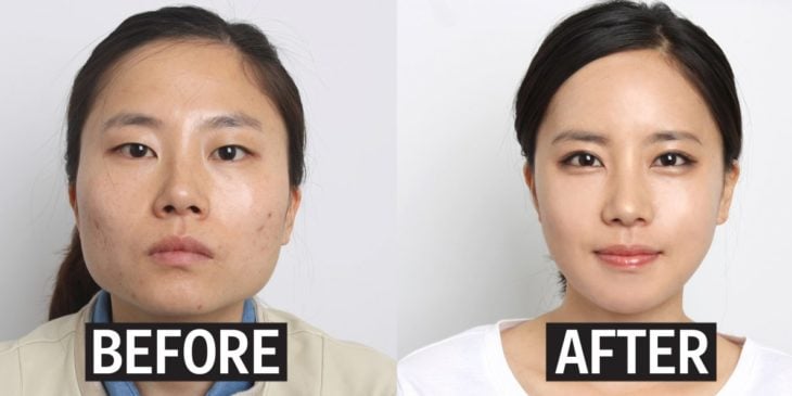 antes y después de cirugía de rostro corea