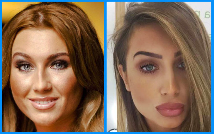 Lauren Goodger antes y después de la cirugía