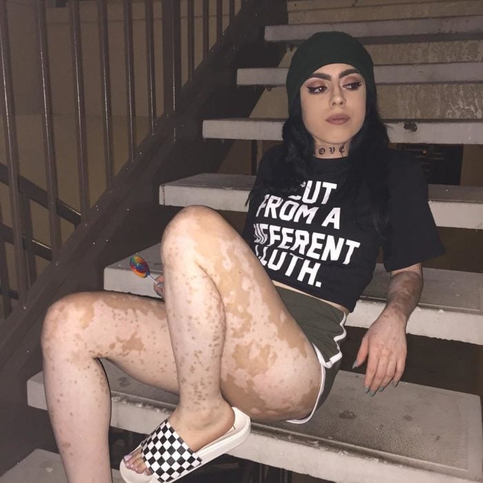 MUJER CON VITILIGO SE HACE FAMOSA EN INSTAGRAM