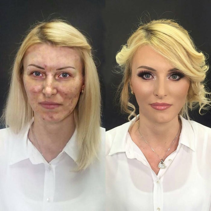 mujer rubia con acné antes y después de maquillarse
