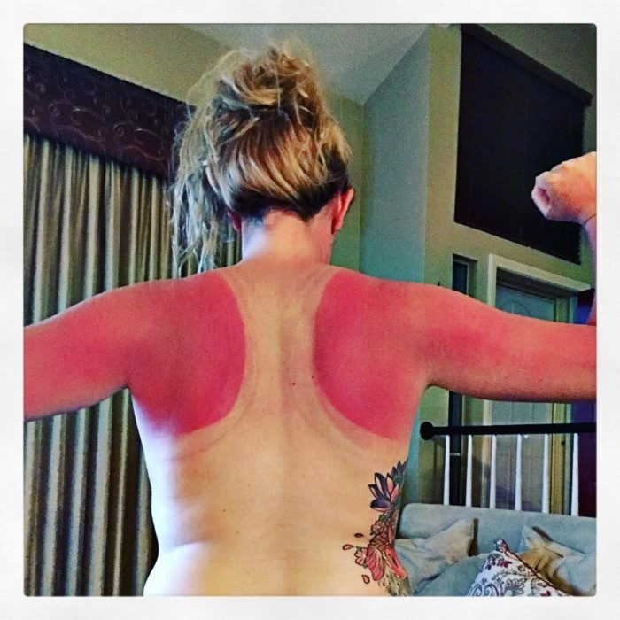 mujer con marcas de camiseta por quemaduras de sol