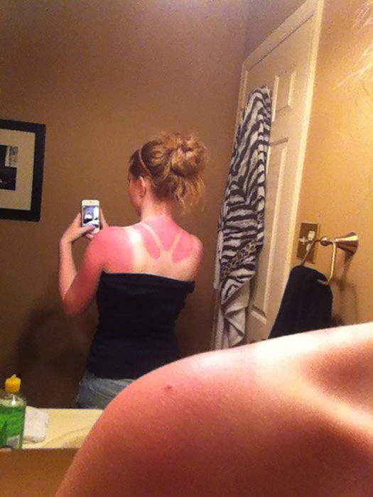 mujer se toma fotografía en el espejo de su espalda quemada por el sol
