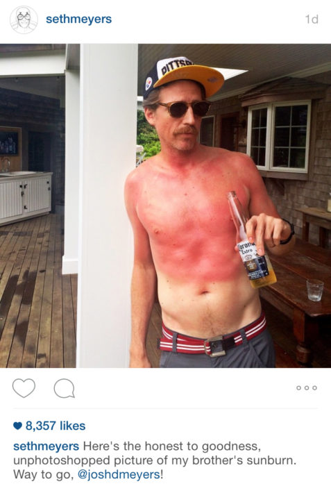 hombre con quemadura solar y una cerveza en la mano