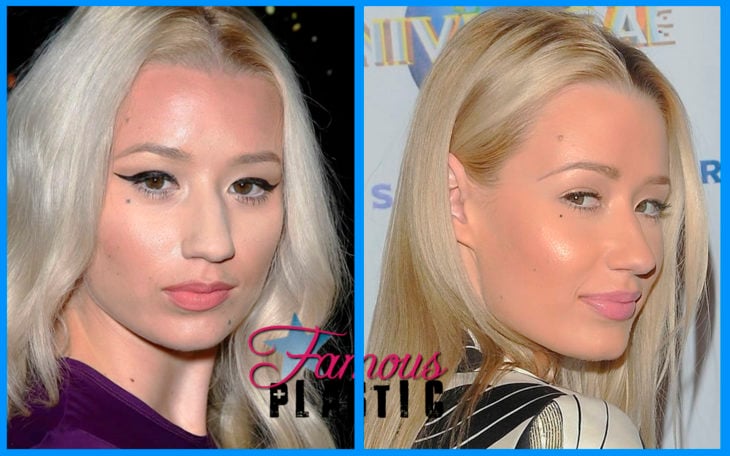 iggy azalea antes y después de la cirugía