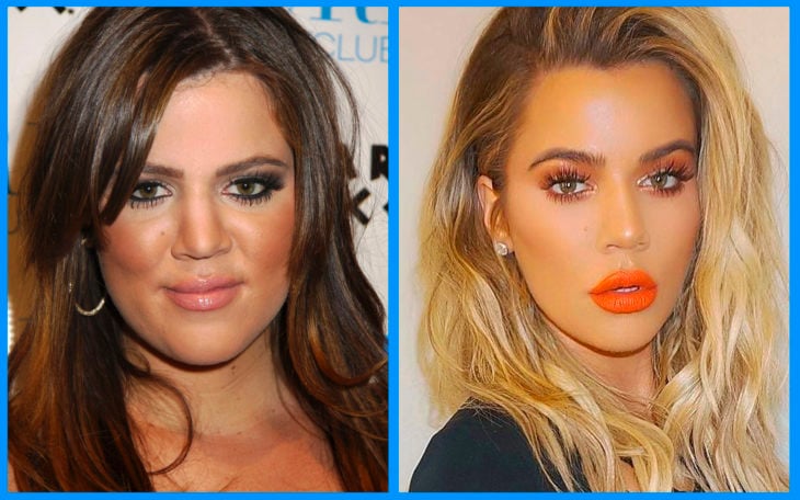 khloe kardashian antes y después de la cirugía