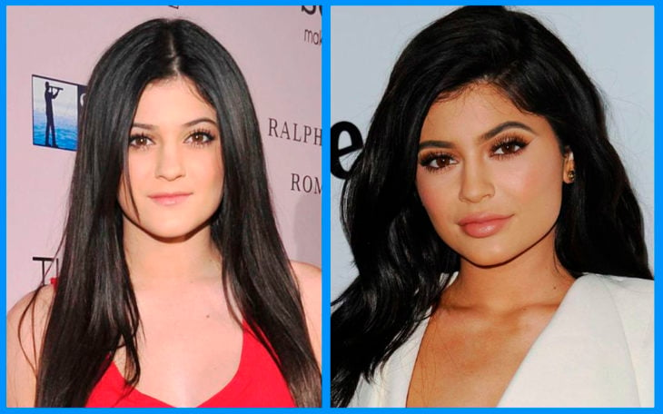 kylie jenner antes y después de la cirugía