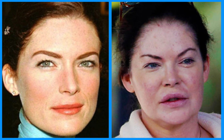 lara flynn boyle antes y después de la cirugía