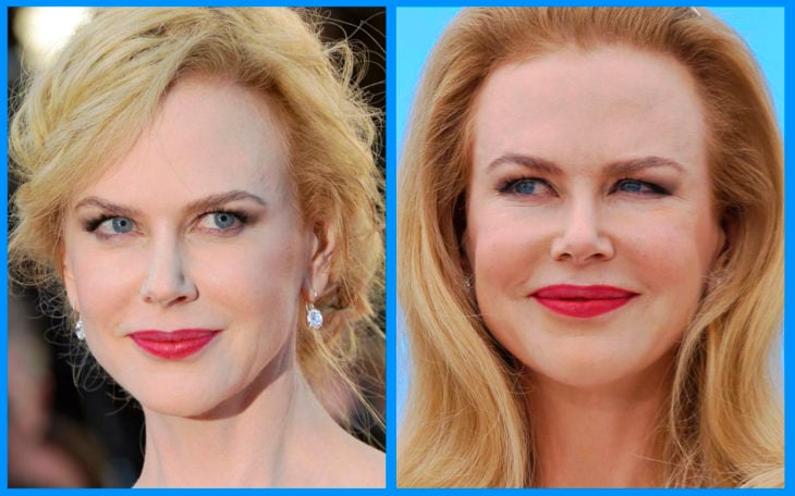 nicole kidman antes y después de la cirugía