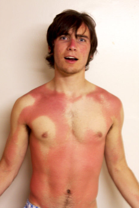 chico con manchas rojas por quemaduras solares