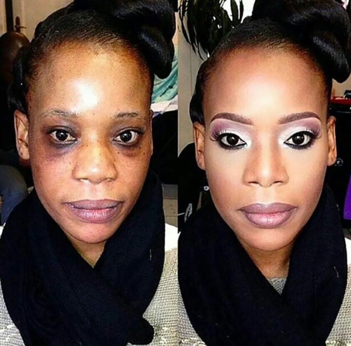 mujer de color con ojeras muy marcadas antes y después de mauillarse