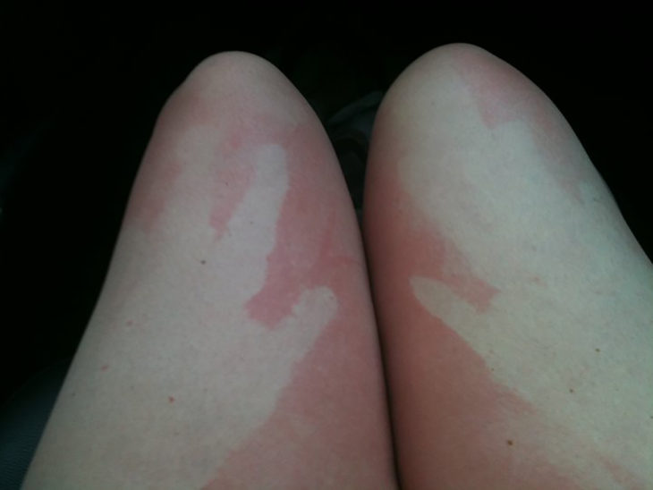 chica con marcas de las manos en las piernas por quemadura solar