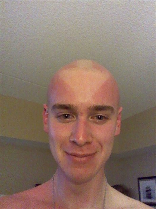 hombre con marca de un triángulo en la cabeza debido a quemadura solar