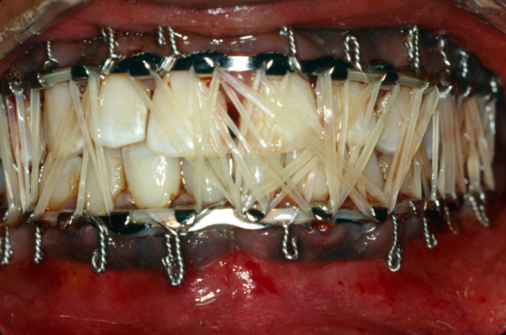 dientes con braquets y ligas