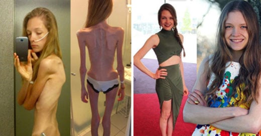 Cover impactantes transformaciones del antes y después de la anorexia