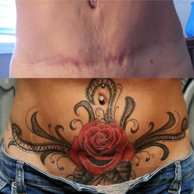 22 Cicatrices que se convirtieron en asombrosos tatuajes