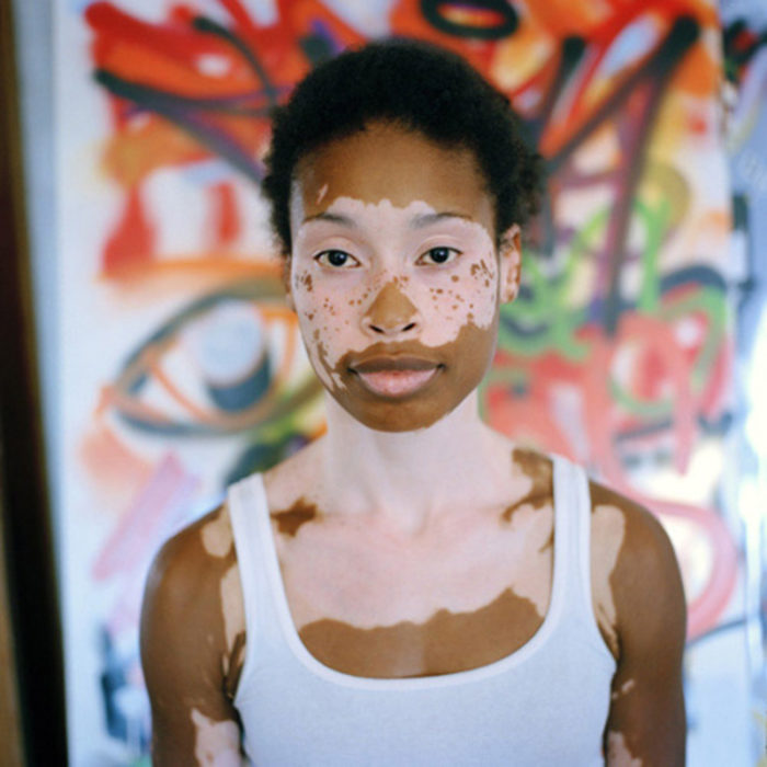 Mujer hermosa vitiligo