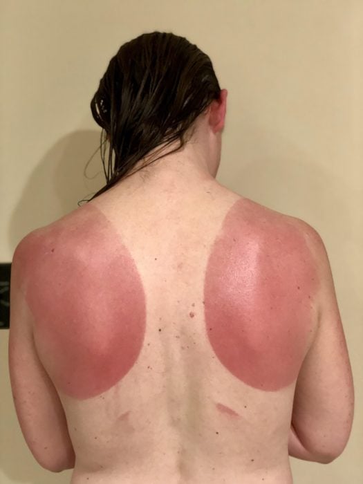mujer con quemaduras solares en la espalda